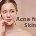 Skin Care Routine For Acne Skin